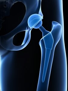 x ray diagram of a hip replacement