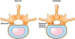 Illustration of a healthy spinal canal vs a spinal canal effected by lumbar spinal stenosis