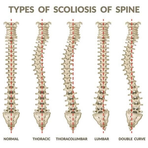 3d illustration of effects of 5 types of scoliosis