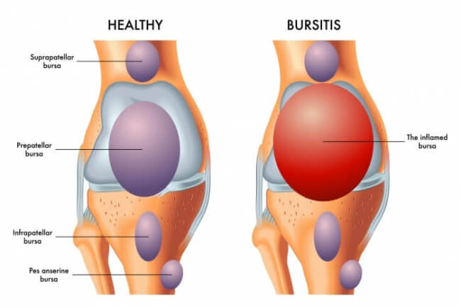 Bursitis vs healthy knee
