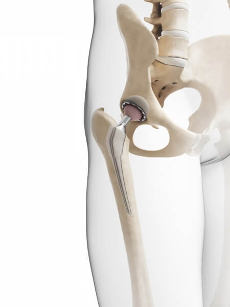 Joint Replacement Center